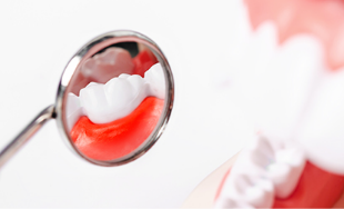虫歯･歯肉炎･歯周病予防