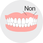 先天性欠損歯