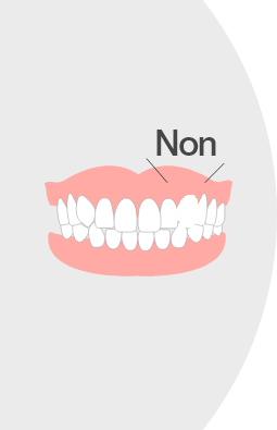 先天性欠損歯(歯が足りない)