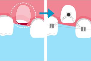 埋まっている歯を引っ張りだす治療