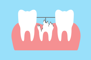 部分的に歯を引っ張る治療