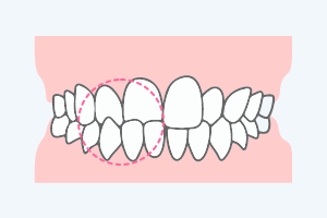 部分的な咬み合わせを改善する治療