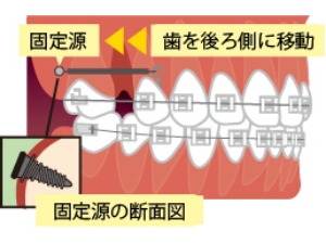 抜歯後の隙間の閉鎖