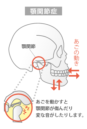 骨格や顎関節への影響